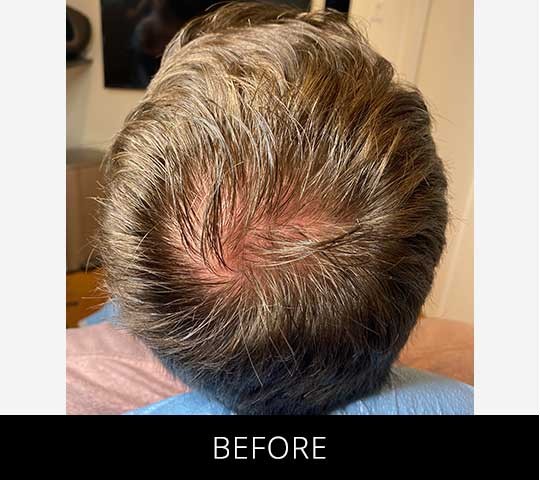 Scalp Camo before and after - before
