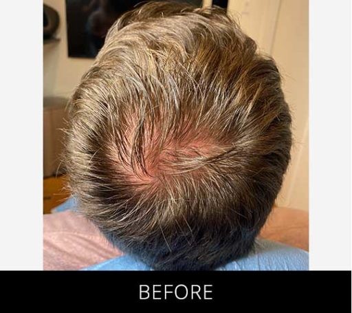 Scalp Camo before and after - before