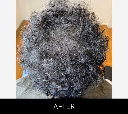 Scalp Camo before and after - after