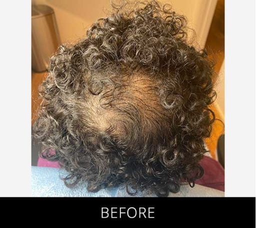 Scalp Camo before and after - before