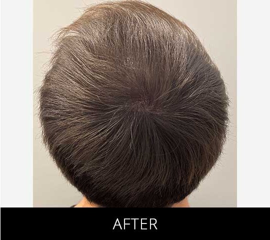 Scalp Camo before and after - after