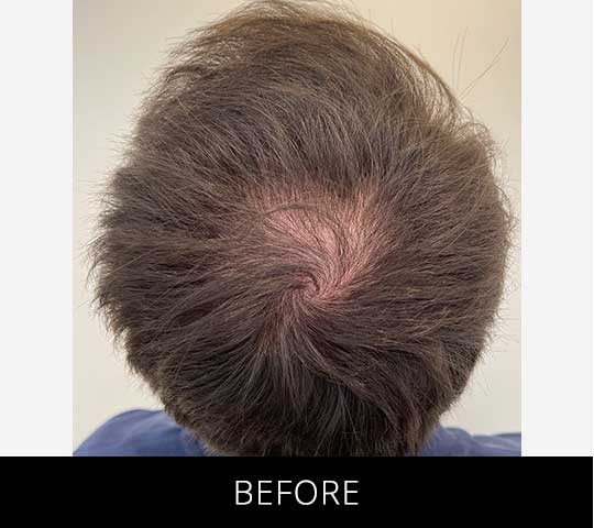 Scalp Camo before and after - before