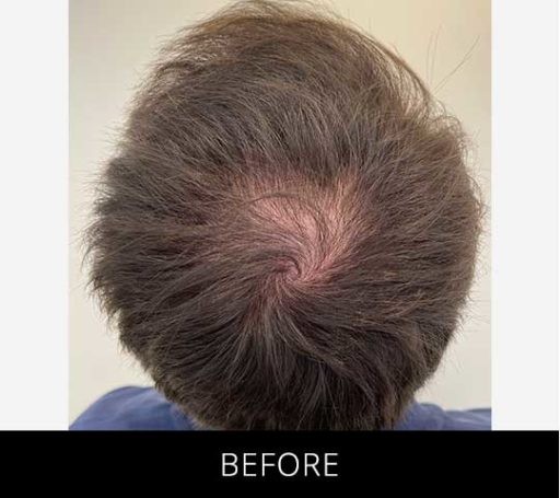 Scalp Camo before and after - before