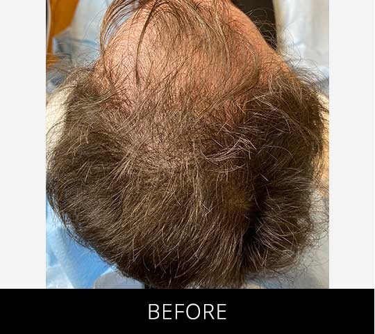 Scalp Camo before and after - before