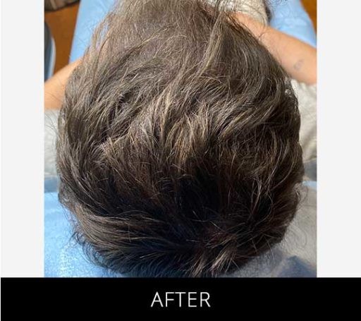 Scalp Camo before and after - after