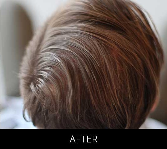 Robotic Hair Restoration before and after - after
