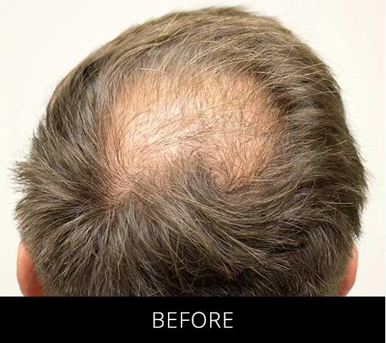 Robotic Hair Restoration before and after - before