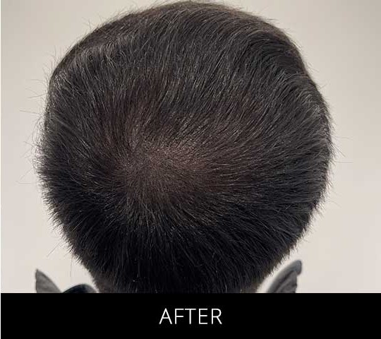 Scalp Camo before and after - after
