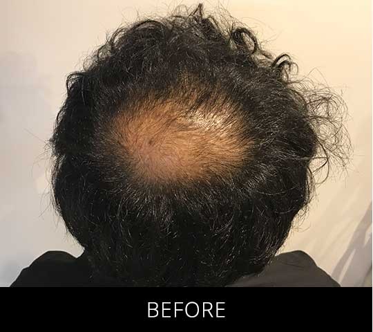 Scalp Camo before and after - before