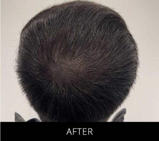 Scalp Camo before and after - after