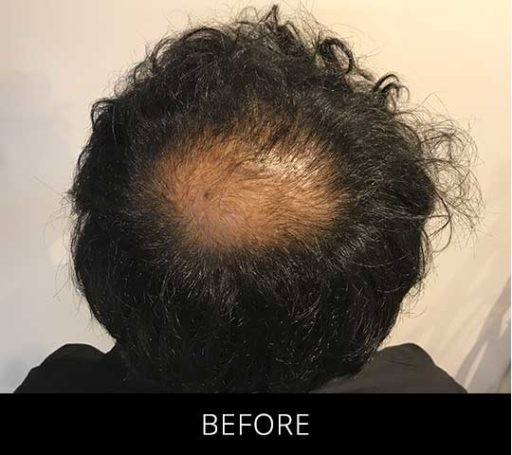 Scalp Camo before and after - before