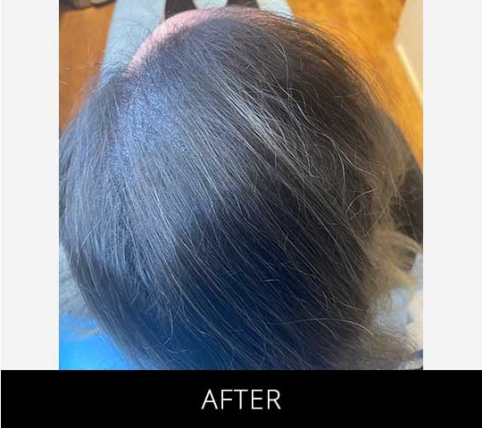 Scalp Camo before and after - after