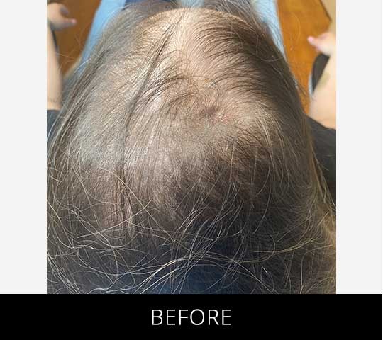 Scalp Camo before and after - before