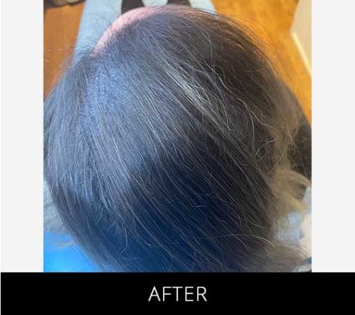 Scalp Camo before and after - after
