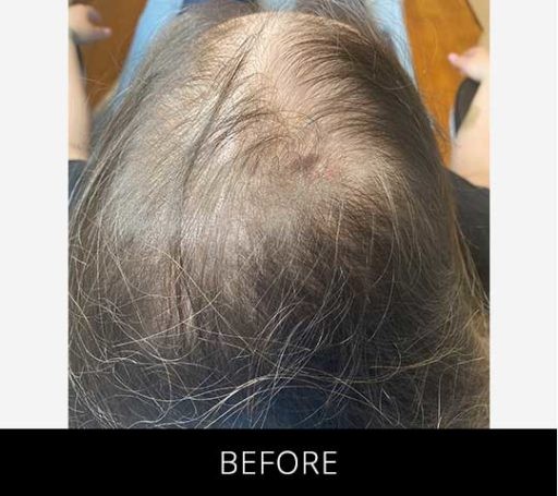 Scalp Camo before and after - before