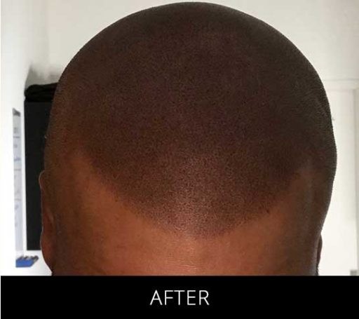 Scalp Camo before and after - after
