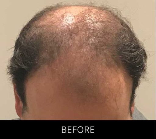 Scalp Camo before and after - before