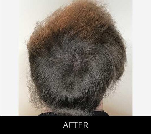 Scalp Camo before and after - after