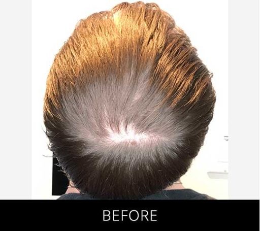 Scalp Camo before and after - before