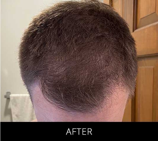 Robotic Hair Restoration before and after - after