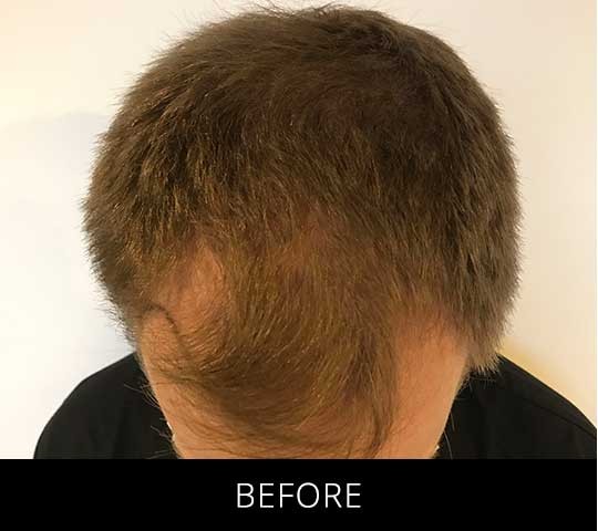 Robotic Hair Restoration before and after - before