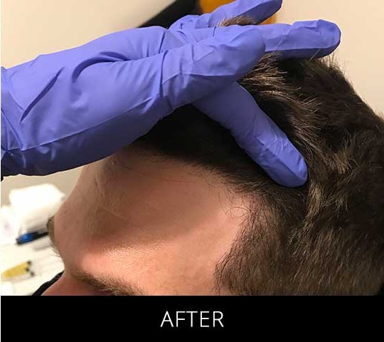 Robotic Hair Restoration before and after - after