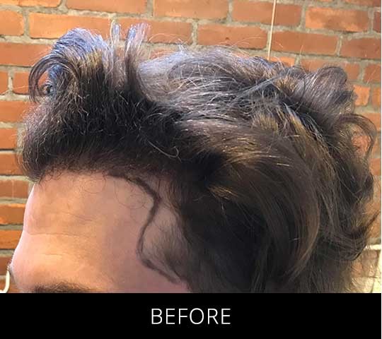 Robotic Hair Restoration before and after - before