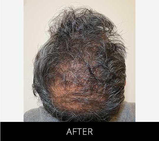 Robotic Hair Restoration before and after - after