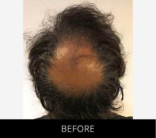 Robotic Hair Restoration before and after - before