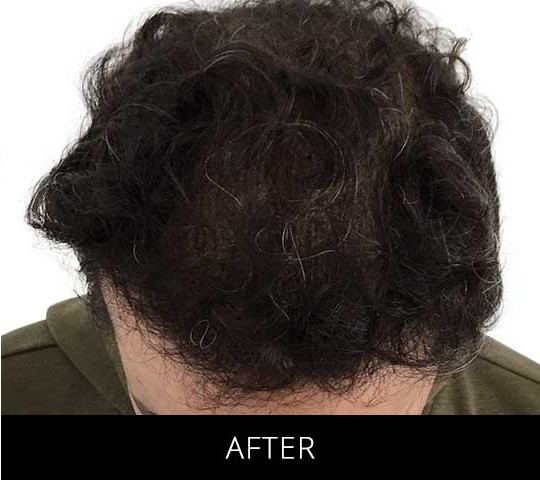 Robotic Hair Restoration before and after - after