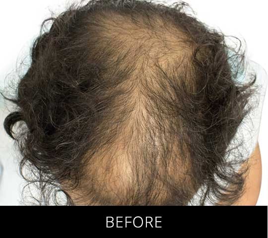 Robotic Hair Restoration before and after - before