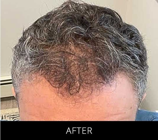 Robotic Hair Restoration before and after - after