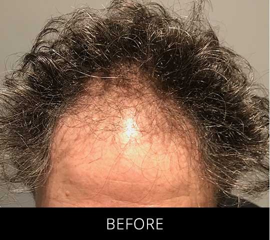 Robotic Hair Restoration before and after - before