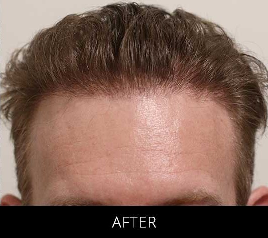 Robotic Hair Restoration before and after - after