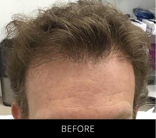 Robotic Hair Restoration before and after - before