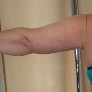 Procedure before and after - before