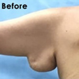 Arm Lift before and after - before