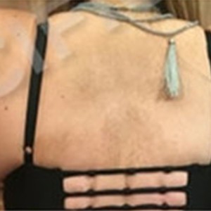 Arm Lift before and after - after