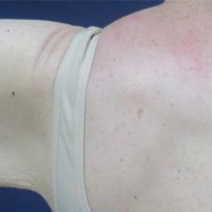 Procedure before and after - after