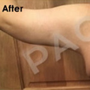 Procedure before and after - before
