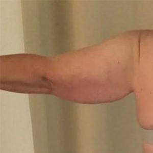 Arm Lift before and after - before