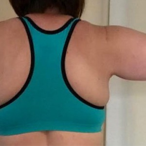 Arm Lift before and after - after