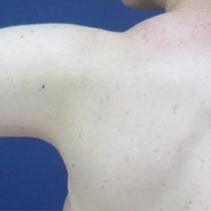 Arm Lift before and after - after
