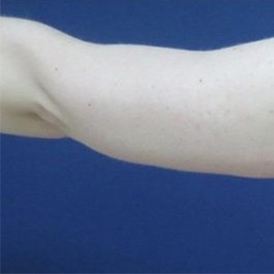 Arm Lift before and after - before