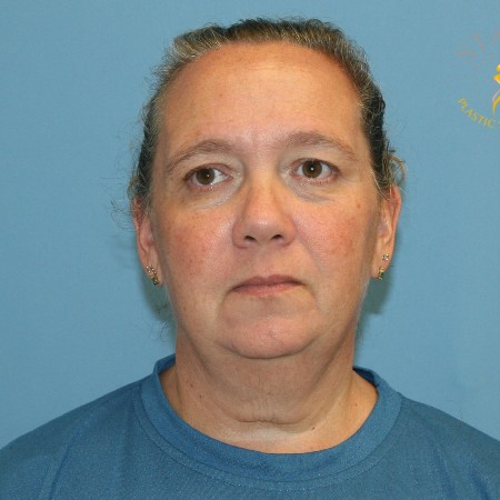 Neck Lift before and after - before