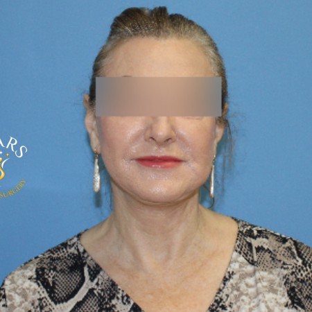 Facelift before and after - after