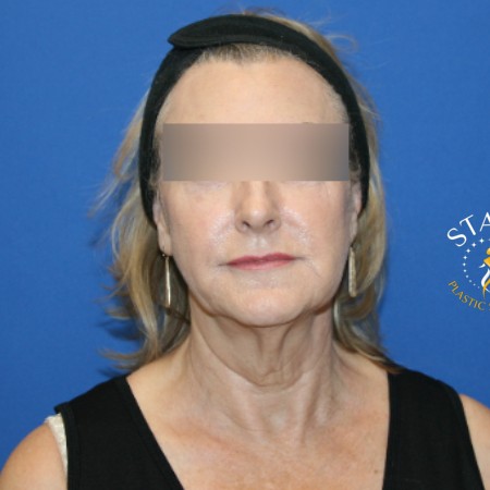 Facelift before and after - before