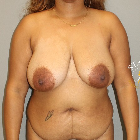 Breast Reduction before and after - before