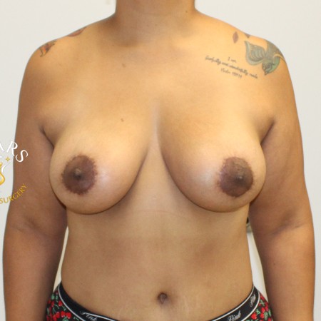 Breast Reduction before and after - after
