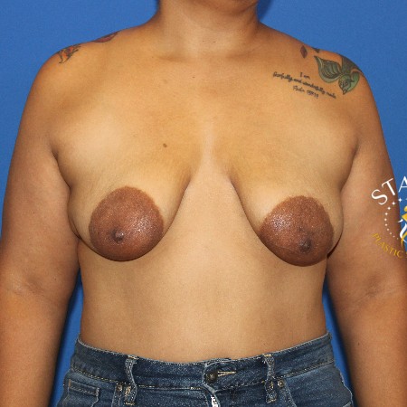 Breast Reduction before and after - before